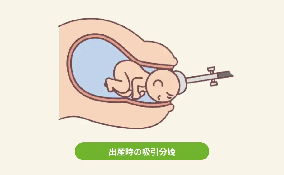 吸引分娩中の赤ちゃんのイラスト