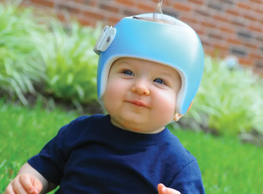 スターバンドのヘルメット治療を受けている赤ちゃんの写真
