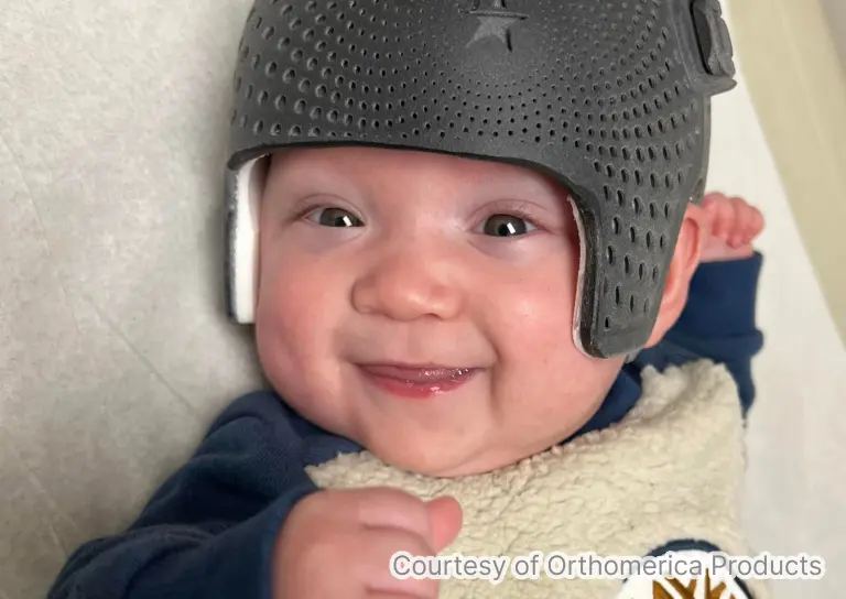 スターバンド3Dにてヘルメット治療を受けている赤ちゃんの写真