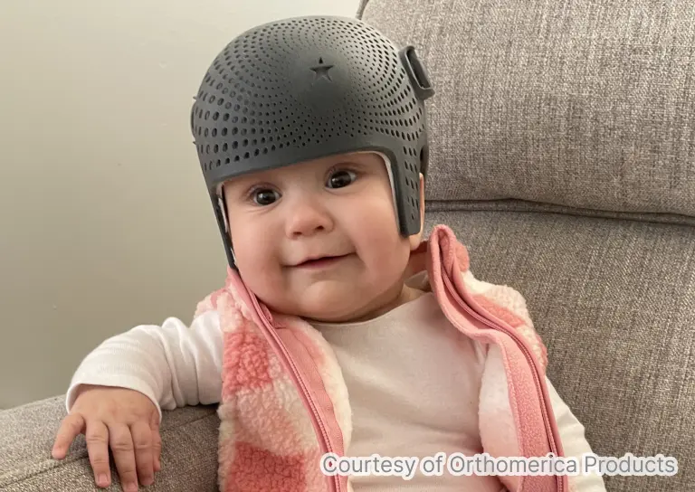 スターバンド3Dにてヘルメット治療を受けている赤ちゃんの写真
