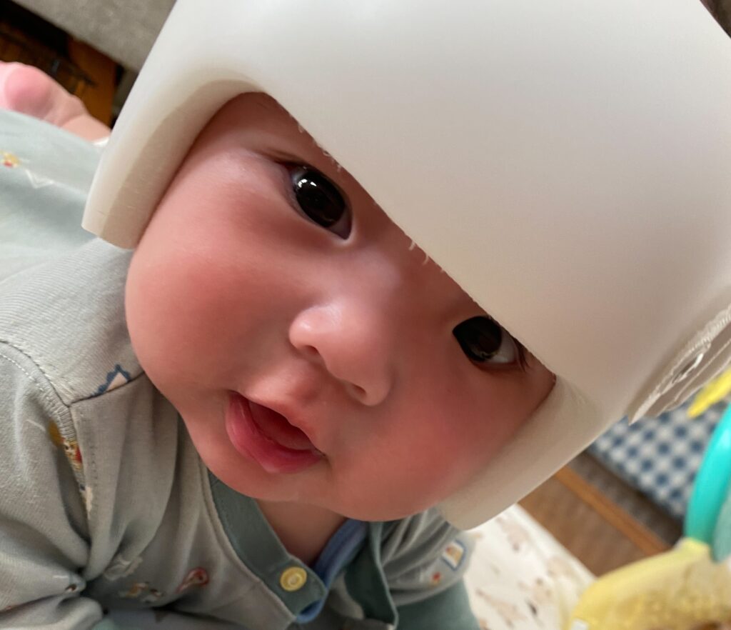 吸引分娩で赤ちゃんの頭の形(短頭+斜頭)に悩むお母さん