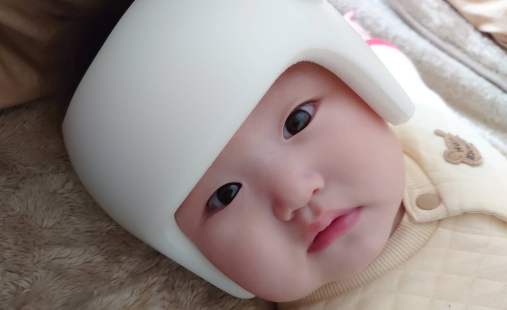 星の子体験談に新しいお便りが届きました‼：アミちゃん（短頭 斜頭）